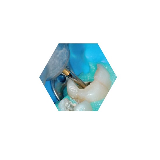 Broca Endo Z 23mm N° 152 FG Prima Dental